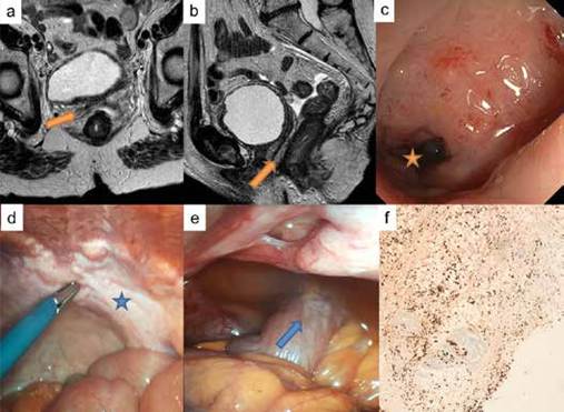Caso 1. a, b) Imagen axial y sagital de tomograf&iacute;a computarizada, donde se aprecia el engrosamiento rectal extr&iacute;nseco y del saco de Douglas (flecha naranja). c) Imagen endosc&oacute;pia de la estenosis extr&iacute;nseca (estrella naranja) con mucosa de aspecto normal. d) Imagen de laparoscopia donde se aprecia el engrosamiento del saco de Douglas o &ldquo;escudo de Blumer&rdquo; (estrella azul). e) Imagen laparosc&oacute;pica donde se aprecia el compromiso tumoral rectal subseroso o linitis pl&aacute;stica rectal secundaria (flecha azul). f) Imagen microsc&oacute;pica de anatom&iacute;a patol&oacute;gica de la biopsia del saco de Douglas con infiltraci&oacute;n subserosa por carcinoma difuso. Inmunohistoqu&iacute;mica de CK8+, aumento x10.