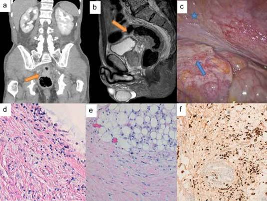 Caso 2. a, b) Imagen axial y sagital de resonancia nuclear, donde se aprecia el engrosamiento rectal extr&iacute;nseco y del saco de Douglas (flecha naranja). c) Imagen de laparoscopia, donde se aprecia el engrosamiento del saco de Douglas o &ldquo;escudo de Blumer&rdquo; (estrella azul) y el compromiso tumoral rectal subseroso o linitis pl&aacute;stica rectal secundaria (flecha azul). d, e) Im&aacute;genes microsc&oacute;picas de anatom&iacute;a patol&oacute;gica, de las biopsias del saco de Douglas con infiltraci&oacute;n subserosa por carcinoma difuso, HE (Hematoxilina Eosina) aumento x10. f) Im&aacute;genes microsc&oacute;picas de anatom&iacute;a patol&oacute;gica, de las biopsias del saco de Douglas con infiltraci&oacute;n subserosa por carcinoma difuso. Inmunohistoqu&iacute;mica de CK8+, aumento x10.