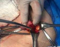 Regi&oacute;n inguinal derecha. Se observa el ap&eacute;ndice cecal contenida en el saco herniario (1) y el lipoma herniario (2).