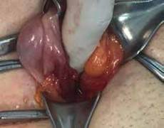 Regi&oacute;n inguinal derecha. Se observa el ap&eacute;ndice cecal contenida en el saco herniario (1) y el lipoma herniario (2).