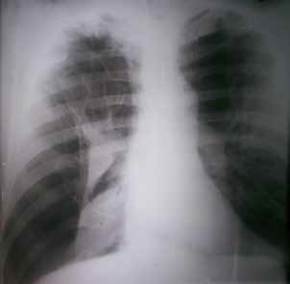 Radiograf&iacute;a de t&oacute;rax, postero-anterior y en bi-pedestaci&oacute;n, en la que se observa el colapso del pulm&oacute;n derecho con m&uacute;ltiples bullas enfisematosas en ambos campos pulmonares.