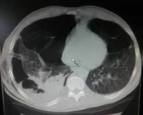 Tomograf&iacute;a computarizada de t&oacute;rax en la que se observa escaso par&eacute;nquima pulmonar, con m&uacute;ltiples bullas de diferentes tama&ntilde;os localizadas en ambos campos pulmones, algunas de ellas con niveles hidroa&eacute;reos en su interior en la base del hemit&oacute;rax derecho. Tambi&eacute;n, se observa moderado colapso pulmonar derecho.