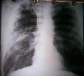 Radiograf&iacute;a de t&oacute;rax, postero-anterior y en bipedestaci&oacute;n, en la que se aprecia la reexpansi&oacute;n del pulm&oacute;n derecho, adem&aacute;s de m&uacute;ltiples bullas enfisematosas en ambos campos pulmonares.