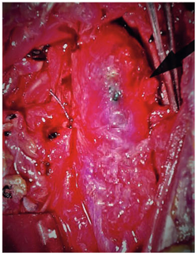 Hallazgo intraoperatorio de la invasi&oacute;n tumoral por el glomus sin plano de clivaje.