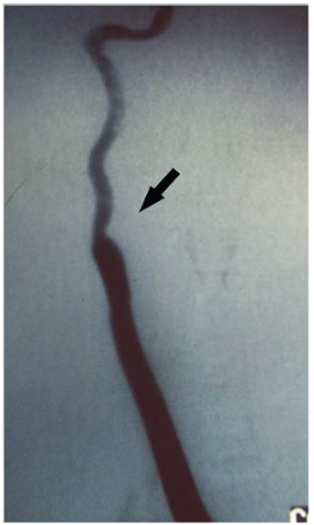 Arteriograf&iacute;a carotidea posoperatoria que muestra el flujo carotideo restituido de la car&oacute;tida primitiva a la car&oacute;tida interna con injerto venoso. Ausencia de car&oacute;tida externa.