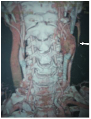 Angiotomograf&iacute;a de vasos del cuello con reconstrucci&oacute;n en 3D. Se observa el glomus y la p&eacute;rdida del plano de separaci&oacute;n tumor-vaso.