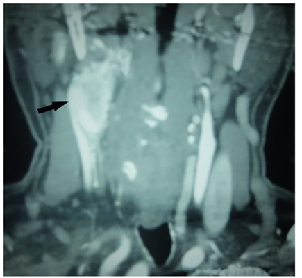 Corte coronal de tomograf&iacute;a contrastada de cuello que sugiere deformidad vascular por invasi&oacute;n en la bifurcaci&oacute;n Carotidea.