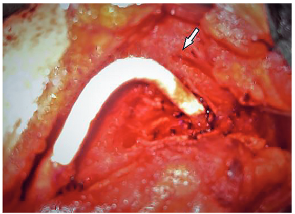 Injerto de Gore-tex implantado entre la car&oacute;tida primitiva y la car&oacute;tida interna.