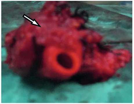 Invasi&oacute;n del tumor a la arteria car&oacute;tida primitiva.