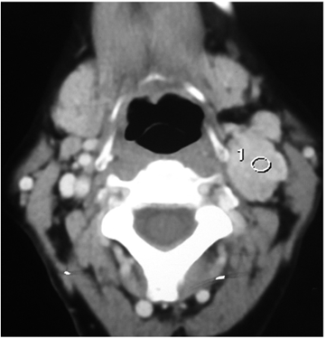 Tomograf&iacute;a axial con contraste, en la que se observa el tumor del glomus carotideo Shamblin III.