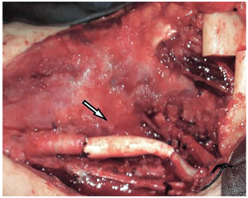 Remplazo arterial con injerto de Gore-tex de la car&oacute;tida primitiva a la car&oacute;tida interna.