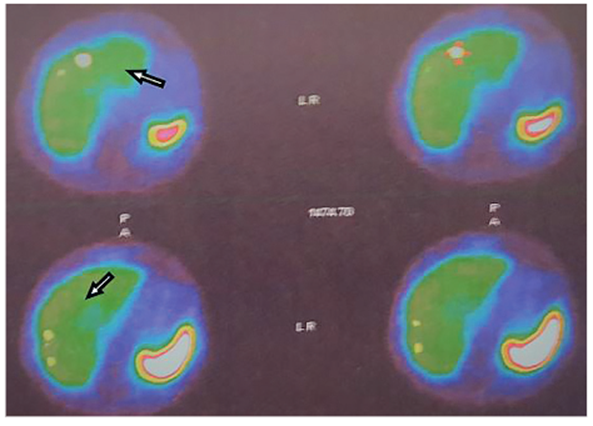 Escanograf&iacute;a (posoperatoria) con octreotido que muestra las lesiones hipercaptantes por las met&aacute;stasis hep&aacute;ticas.