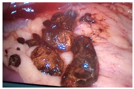 Moldes de c&aacute;lculos gigantes hallados en la exploraci&oacute;n laparosc&oacute;pica directa.