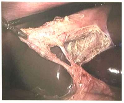 Visión crítica de seguridad. 1) El triángulo hepatocístico se ha diseccionado sin grasa ni tejido fibroso, no se muestra el conducto biliar principal. 2) La base de la vesícula biliar se ha diseccionado en su tercio inferior exponiendo la placa cística. 3) Dos y solo dos estructuras ingresan a la vesícula biliar y pueden verse circunferencialmente.