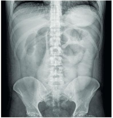 Imagen radiol&oacute;gica que muestra la falta de progresi&oacute;n del medio de contraste.