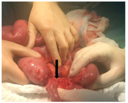 Zona de estenosis en el intestino delgado.