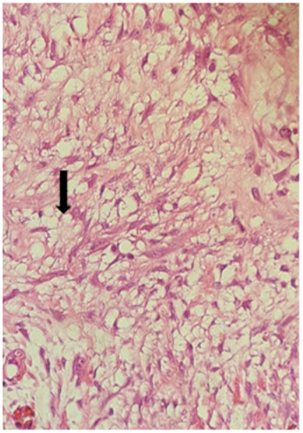 Lipodistrofia del mesenterio: macr&oacute;fagos espumosos cargados de l&iacute;pidos junto a fibras de col&aacute;geno (hematoxilina-eosina 20X).
