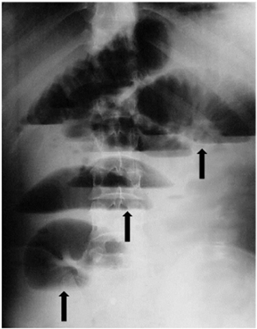 Radiografía simple de abdomen en bipedestación. Las flechas muestran los niveles hidroaéreos centrales en escalera y la distensión de asas yeyunales e ileales.