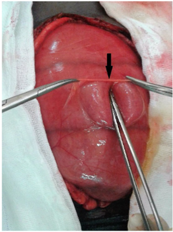 Transoperatorio. La flecha muestra el saco herniario abierto con distensión de asas intestinales delgadas.