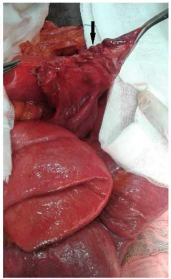 Transoperatorio. Cierre del orificio herniario con sutura continua no absorbible (flecha negra).