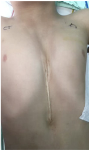 Fotograf&iacute;a de la pared anterior del paciente donde se evidencia el defecto de la l&iacute;nea media con agenesia completa del estern&oacute;n, con visualizaci&oacute;n del movimiento cardiaco a trav&eacute;s de la piel y con un rafe en l&iacute;nea media que se extiende desde el ombligo hasta el defecto esternal.
