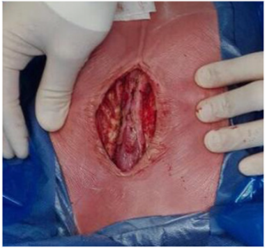 Se observa incisi&oacute;n en l&iacute;nea media tor&aacute;cica con pericardio expuesto en el extremo inferior.