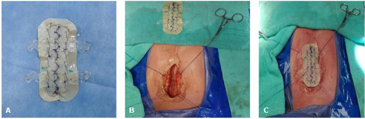 A. Placa de Biobridge y pericardio bovino de 10 cm x 4.5 cm. B. Relaci&oacute;n del &ldquo;neoestern&oacute;n&rdquo; con el defecto del paciente. C. Instalaci&oacute;n de la pr&oacute;tesis o &ldquo;neoestern&oacute;n&rdquo;.