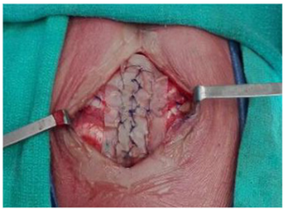 &ldquo;Neoestern&oacute;n&rdquo; fijado a la pared tor&aacute;cica anterior.