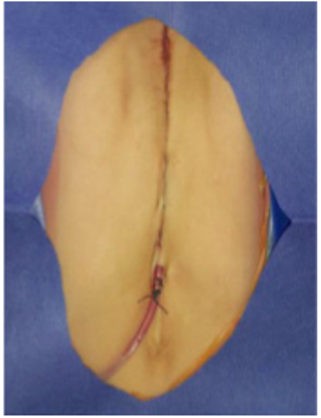 Resultado final con dren de Jackson Pratt en el extremo inferior de la herida quir&uacute;rgica.