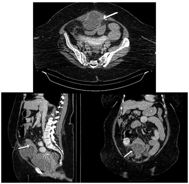 Tomograf&iacute;a computarizada de abdomen contrastada: se observa el remanente del uraco abscedado, que condiciona obstrucci&oacute;n intestinal por compresi&oacute;n extr&iacute;nseca de un asa delgada.