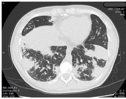 Tomograf&iacute;a de t&oacute;rax de alta resoluci&oacute;n con imagen de consolidaciones bibasales confluentes.