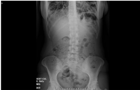 Radiograf&iacute;a simple de abdomen con abundante cantidad de material fecal en el marco cólico por probable estreñimiento, sin signos de obstrucción intestinal ni neumoperitoneo.