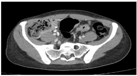 Tomograf&iacute;a de abdomen con imagen de engrosamiento concéntrico de las paredes del colon sigmoide.