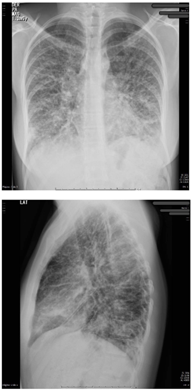 Radiograf&iacute;a de t&oacute;rax proyecci&oacute;n AP y lateral con opacidades reticulares bilaterales en 4 cuadrantes.