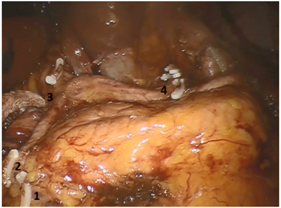 Vaciamiento suprapancreático finalizado. 1. Muñón de vena gastroepiplóica derecha. 2. Muñón de arteria gastroepiplóica derecha. 3. Muñón de arteria gástrica derecha. 4. Muñón de vasos gástricos izquierdos.