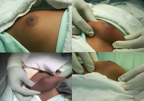 Delimitando el tejido fibroglandular, previo a la incisión periareolar, en paciente con ginecomastia grado IIA según la clasificación de Simon BE.