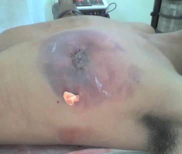Hematoma, complicación postoperatoria más frecuente de la mastectomía subcutánea simple más colgajo.