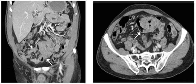 Tomograf&iacute;a computarizada abdominal donde se observa conglomerado de asas intestinales sin establecer causa (flecha).