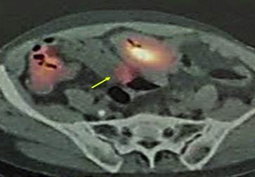 PET-TAC permite ver captaci&oacute;n compatible con tumoraci&oacute;n GIST (flecha).