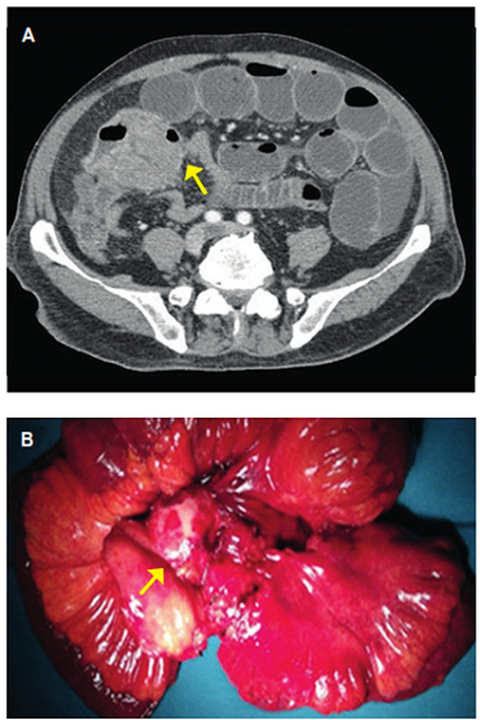 A. Tomograf&iacute;a computarizada abdominal muestra tumoraci&oacute;n abscedada que ocasiona cuadro oclusivo (flecha). B. Pieza quir&uacute;rgica con tumoraci&oacute;n en &iacute;leon terminal que engloba dos asas intestinales, una de ellas torsionada sobre s&iacute; misma condicionando la oclusi&oacute;n (flecha).