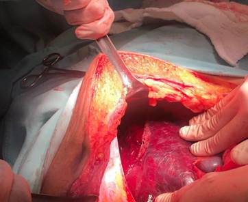 Laparotomía donde se aprecia la ruptura hepática del lóbulo derecho.