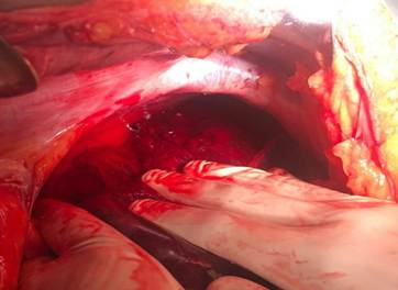 Ruptura hepática de los segmentos VII - VIII.