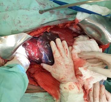 Desempaquetamiento del lóbulo hepático derecho.