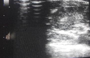 Localización ecográfica del ganglio.