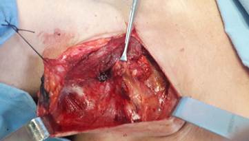 Identificación intraoperatoria del ganglio teñido con azul de metileno.