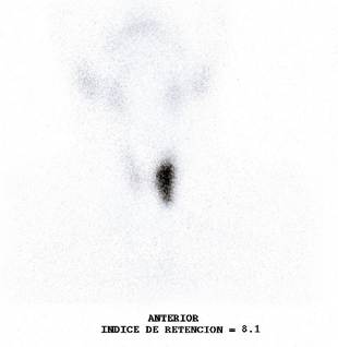 Tc99 thyroid scintigraphy showing a hot nodule located in the left thyroid lobe, which suppresses tracer uptake in the rest of the thyroid parenchyma.