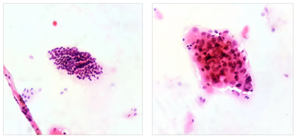 Left,10x magnification. Groups of follicular cells with nuclear crowding are recognized, forming macrofollicles and microfollicles, some of the cells show intranuclear inclusions; Right, 40x magnification. A group of follicular cells with the presence of clefts, intranuclear inclusions, anisonucleosis and hyperchromasia is recognized.