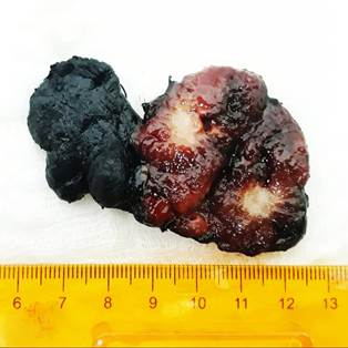 Surface stained with India ink. A surgical specimen corresponding to the product of a total thyroidectomy weighing 10 grams is recognized. In the longitudinal section of the left lobe is recognized a poorly defined nodule, firm on palpation, pearly white in color and irregular contour with a starry appearance. Rest of the parenchyma of usual appearance.