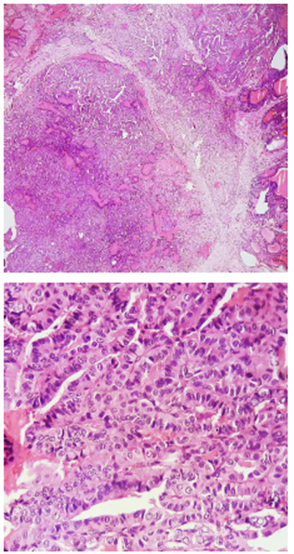 Upper,10x magnification. Lower, 40x magnification. The sections show a malignant epithelial lesion, made up mostly of papillary structures and a minority of moderately defined follicular structures, lined by cuboidal to columnar cells with the presence of round to oval nuclei, with the presence of nuclear clearance, nuclear inclusions and fissures, adopting an infiltrative pattern.