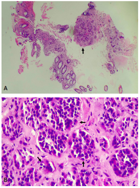 A. 10x. Cortes histol&oacute;gicos donde se aprecia la mucosa col&oacute;nica con una lesi&oacute;n tumoral constituida por peque&ntilde;os acinos bien definidos (flecha), escasamente representados en biopsia de colon. B. 40X. Los acinos est&aacute;n constituidos por c&eacute;lulas de tama&ntilde;o intermedio a peque&ntilde;os, con n&uacute;cleos redondos a ovales, hipercrom&aacute;ticos, con actividad mit&oacute;tica m&iacute;nima a ausente en el material evaluado (flechas).